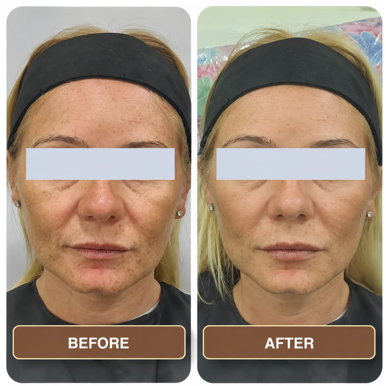 A woman with freckled skin and a dark headband photographed front-on twice, the two shots side by side and labelled Before and After