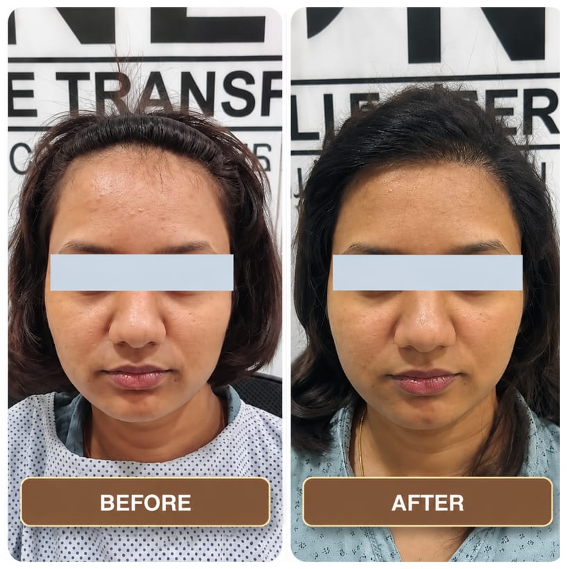 A woman photographed front-on twice showing her forehead and hairline, the two shots side by side and labelled Before and After