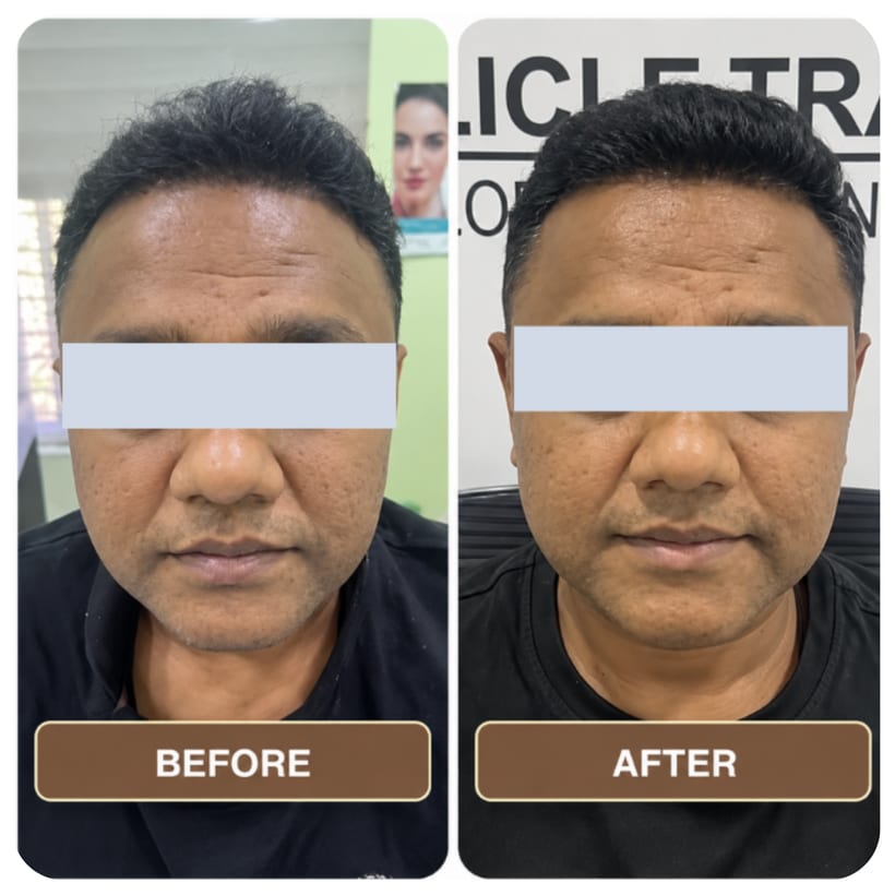 A man photographed front-on twice showing his forehead and hairline, the two shots side by side and labelled Before and After