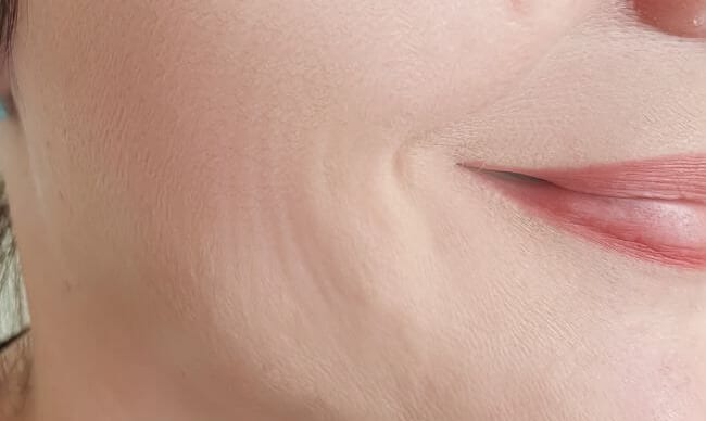 Smoother skin around the mouth and cheek after treatment