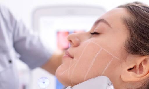 HIFU treatment along the jawline