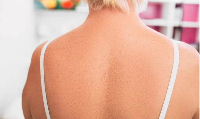 The same area of the back after mole removal