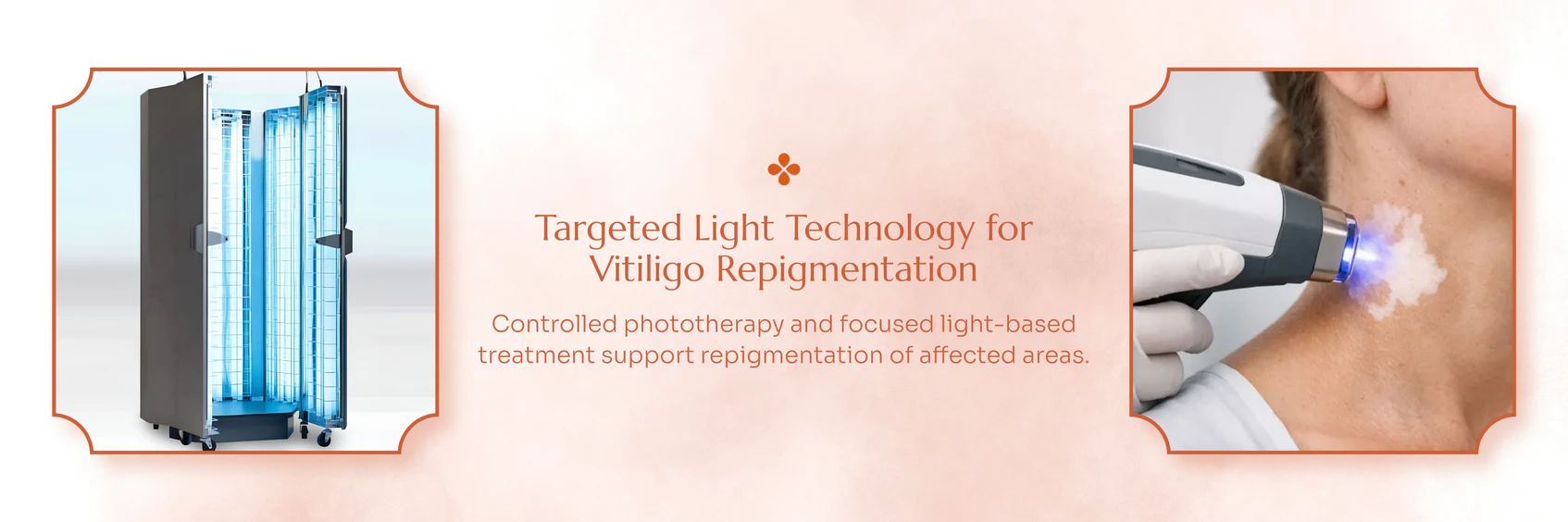 Vitiligo Treatment treatment technology and care information