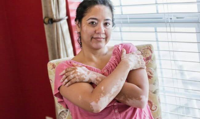 Woman with vitiligo patches on her arms