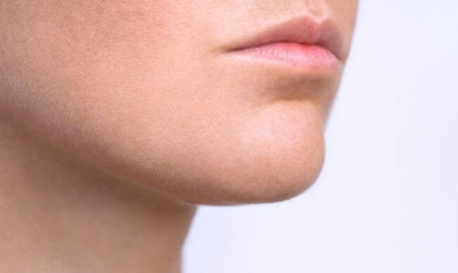 Clear jawline after removal