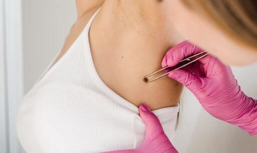 Skin growth being examined before removal