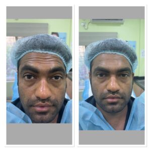 Botox Treatment Before and After