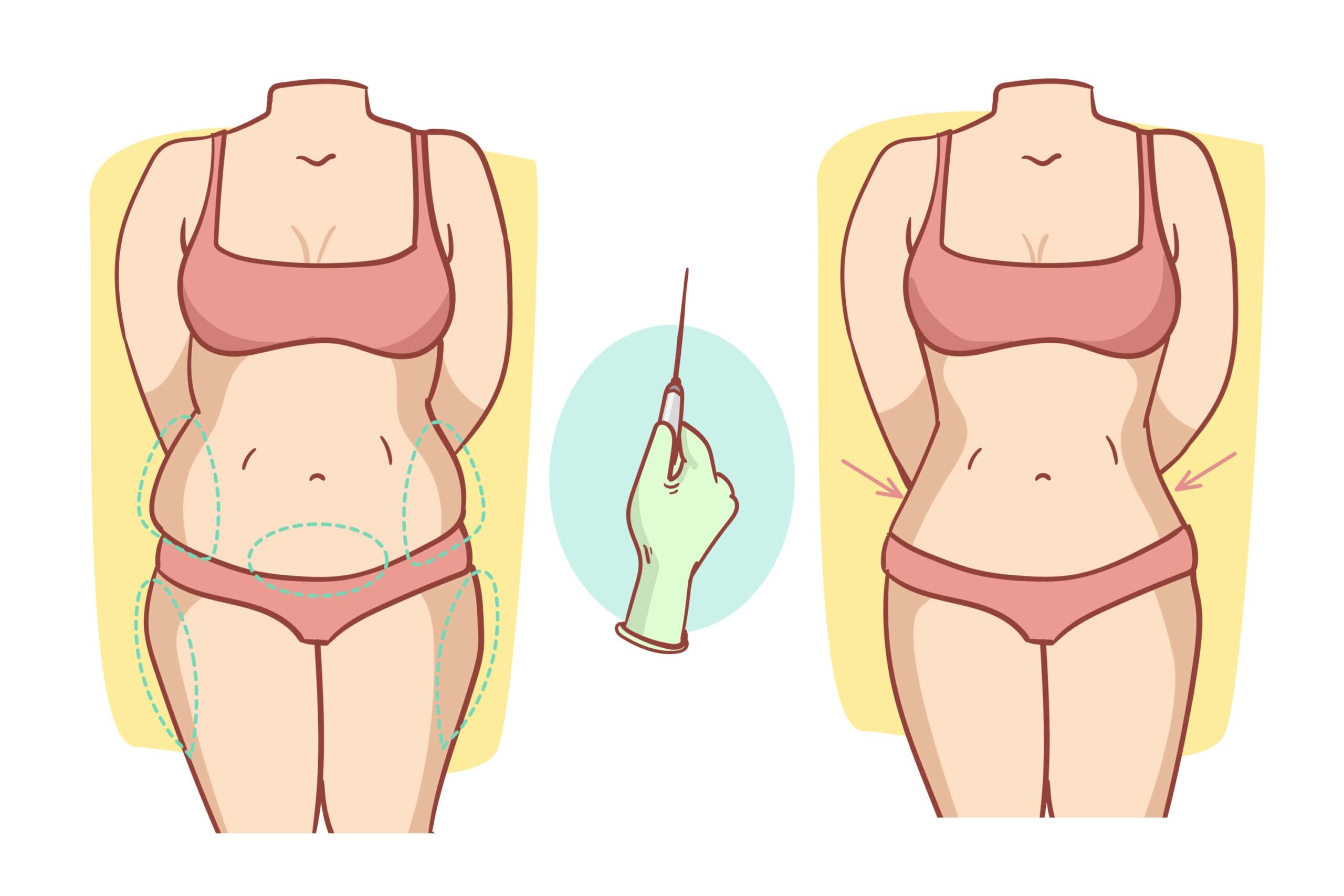 Who Should Consider a Reverse Abdominoplasty