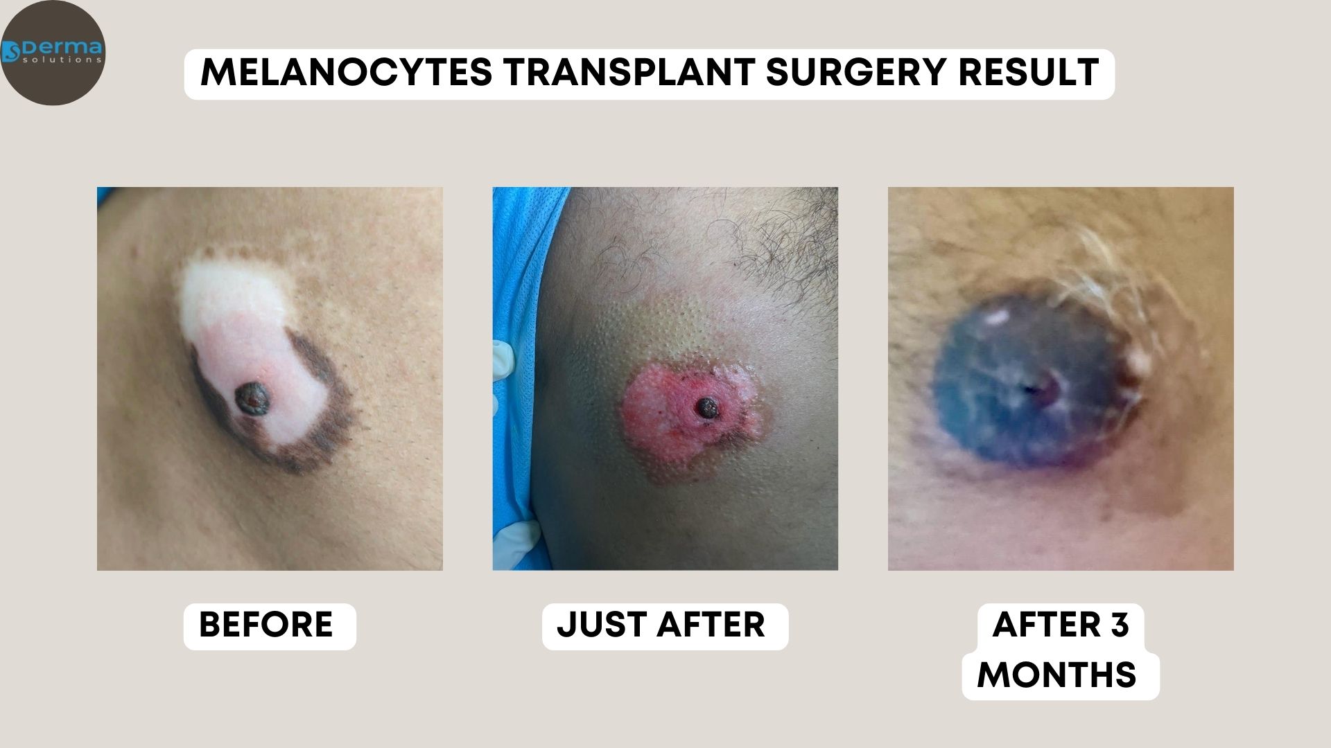 Melanocyte Transplant Surgery